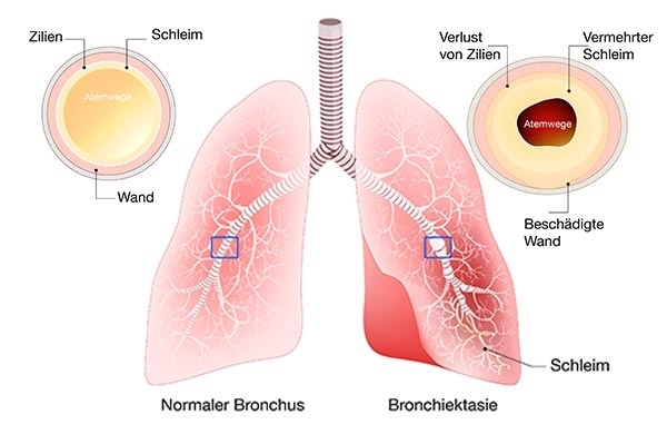 Grafik die veranschaulicht was Bronchiektasen in der Lunge sind