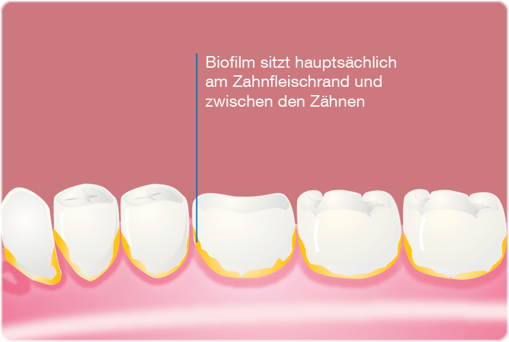 Grafik: Zähne, am Zahnfleischrand ist Plaque