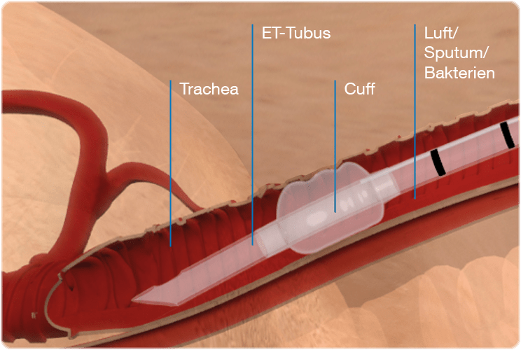 Grafik: Tubus in Luftröhre