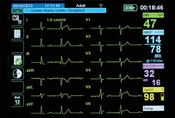 EKG Anzeige auf Bildschirm