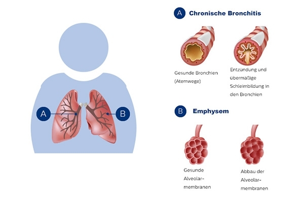 Illustration Erklärung was ist COPD