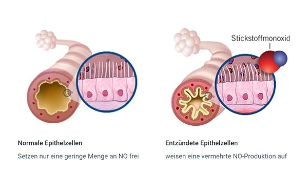 Grafik von normalen und entzündeten Epithelzellen  