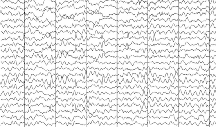 EEG Wellen nicht gesund