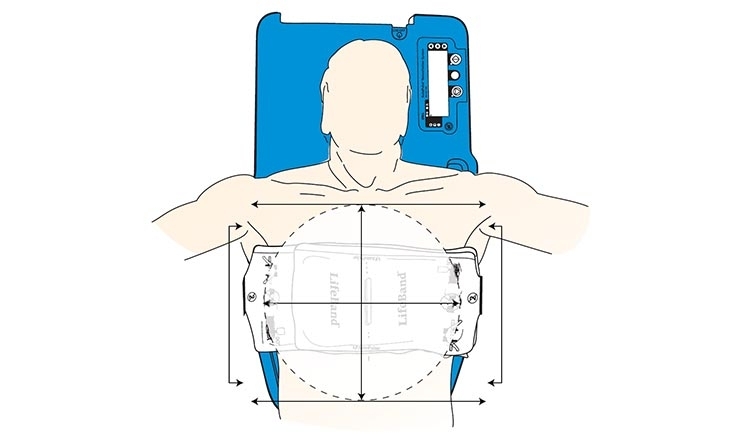 Grafische Darstellung des LifeBand Load-distributing Band auf der Brust eines Patienten